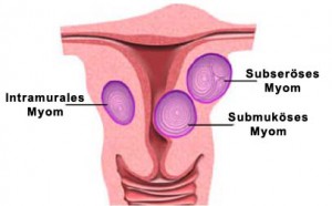 Abbildung: Gebärmutter mit Myomen