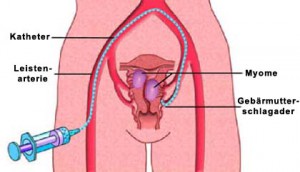 Abbildung: Myom-Embolisation